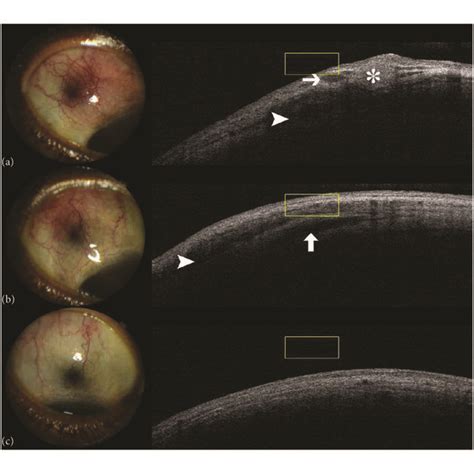 Scleral Ulcer With Calcific Plaque Notes A At Presentation There