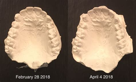 February 28 April 4 2018 Progress Photos Of Dental Casts Case