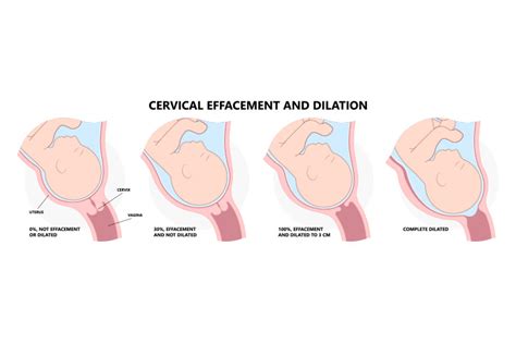 Cervix Dilation Chart Signs Stages And Procedure To Check Off