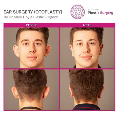 Ear Surgery Plastic Surgery Before And After Images Gold Coast