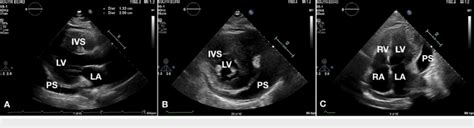 Representative Echocardiographic Images Parasternal Long A