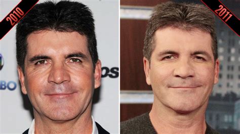 Steve Martin Simon Cowell And More Male Celebs Who May Have Had Plastic Surgery Photos