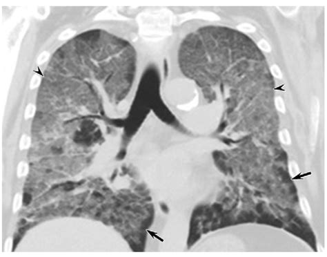 Ct Scans Show Vaping Related Lung Injury Patterns