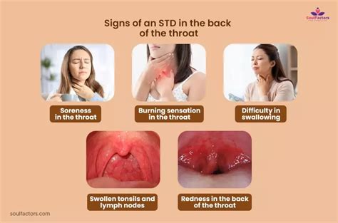 Std In The Throat Symptoms Treatment And Prevention
