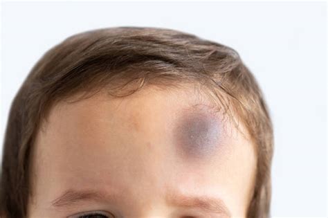 6100 Bruise Head Stock Photos Pictures And Royalty Free Images Istock
