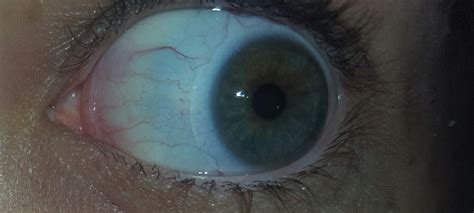 Anyone Else Diagnosed With Ehlers Danlos Syndrome Have The Blue Sclera