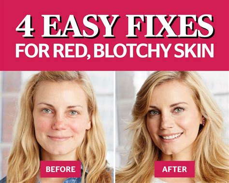 4 Easy Hacks To Get Rid Of Red Blotchy Skin If You Have Sensitive
