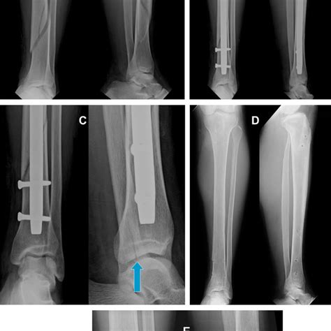 Information For Patients With Concomitant Tibia Shaft Fracture And