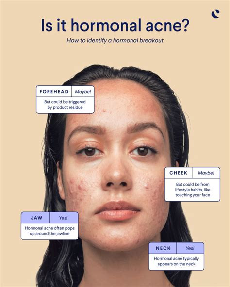 Fact Vs Fiction Does Progesterone Cause Acne