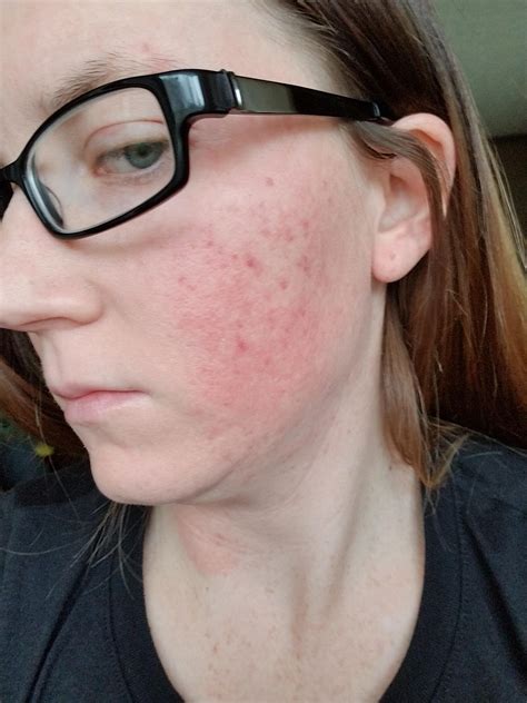Product Question My Face Seems Irritated Help Story Below