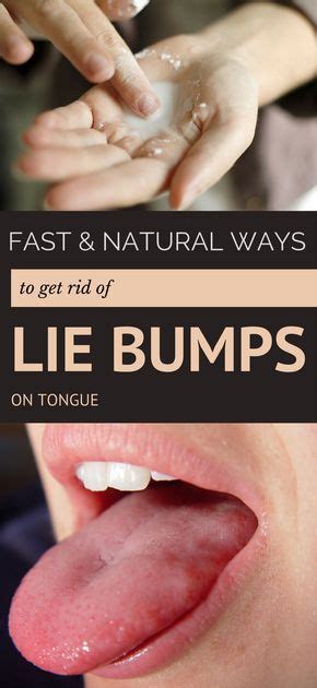 Fast And Natural Ways To Get Rid Of Lie Bumps On Tongue All Beauty