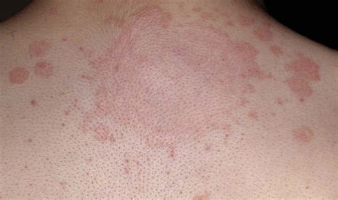 Ringworm What Is It And How Can You Get Rid Of It The Treatment