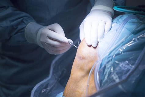 Meniscus Of The Knee Orthofixar Orthopedic Surgery Hot Sex Picture