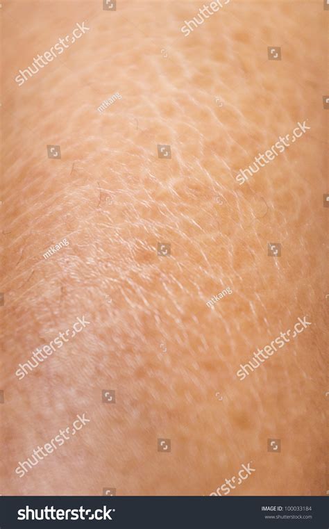 Close Up Shot Of Dry And Cracked Skin Textures On Legs Stock Photo