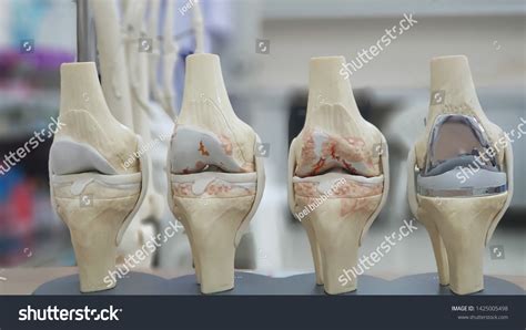 Model Knee Joint Showing Multiple Stages Stock Photo 1425005498