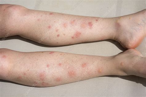 Allergic Reaction To Mosquito Bites Stock Image C Science Photo Library