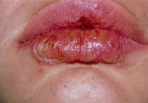 How To Treat Bacterial Infection On Lips