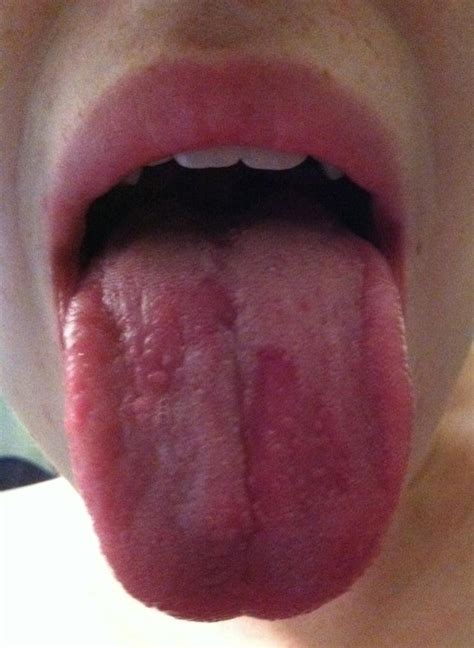 My Geographic Tongue Is Looking Quite Lovely Today Wtf