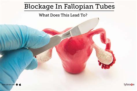 Blockage In Fallopian Tubes What Does This Lead To By Dr Prajakta Ahire Lybrate