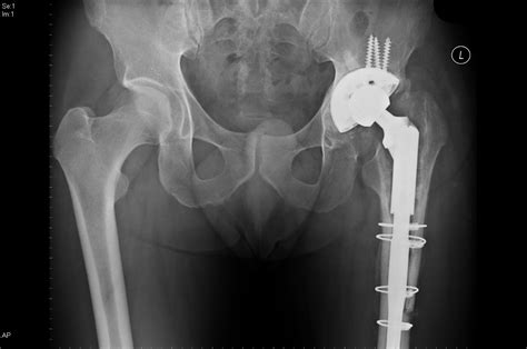 “revision Hip Replacement Can Be Either A Partial Procedure Which