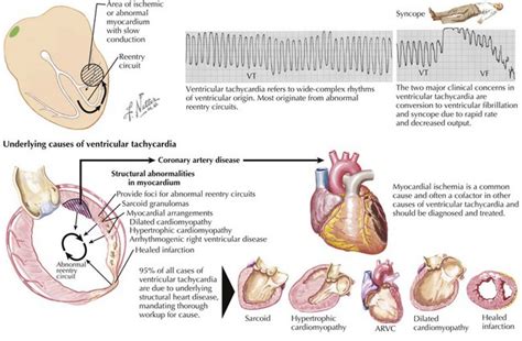 Ventricular Tachycardia Thoracic Key