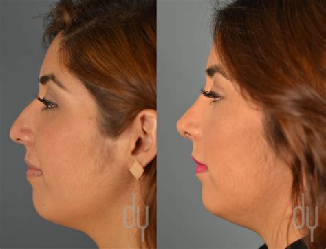 Rhinoplasty Nose Job Before And After Recovery Experience Beverly