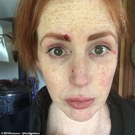 Woman Wakes Up With Black Eye And Swollen Face After Cat Scratch That