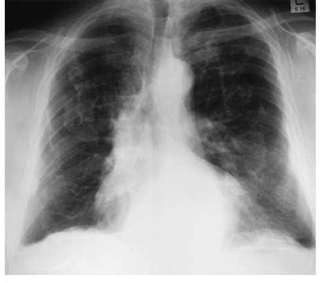 Study Medical Photos Asbestosis And The Pneumoconioses With X Rays