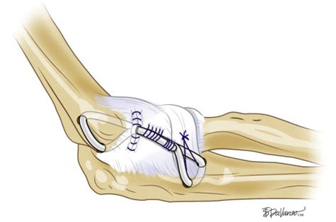 Lateral Posterolateral Rotary Instability Musculoskeletal Key