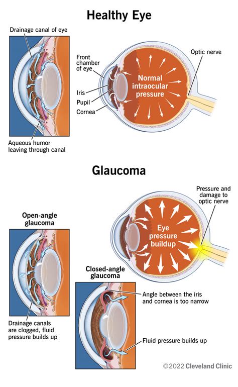 Glaucoma Eye Diagram