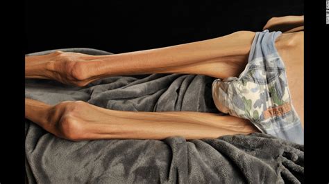 Woman Battling Anorexia Gets Help Via Online Donations