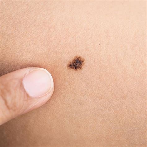 How To Detect Skin Cancer On Clients—and What To Say If You Do