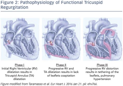 Figure 2 Pathophysiology Of Functional Tricuspid Regurgitation