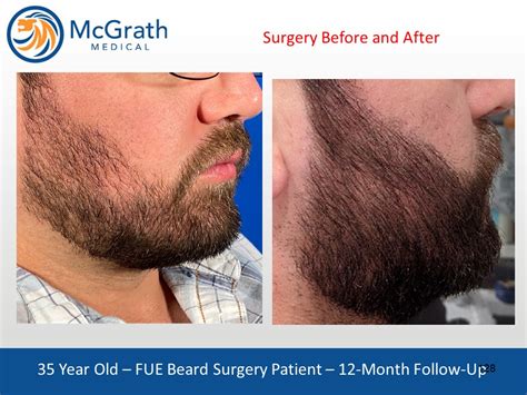 Beard And Facial Hair Transplants Mcgrath Medical