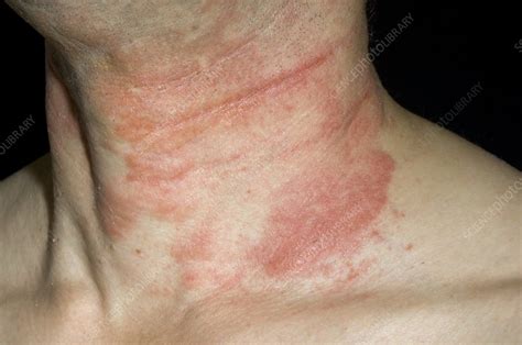 Eczema Rash On The Neck Stock Image C0083601 Science Photo Library