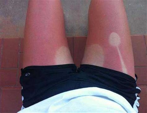 Funny Sunburns That Make Us Glad We Spend All Day On The Internet