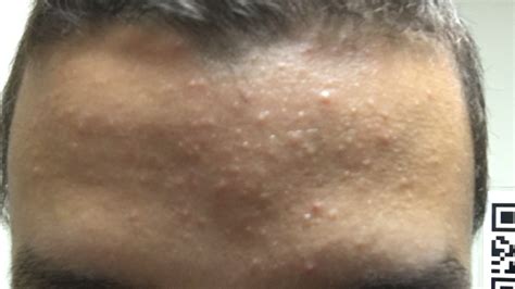 Extremely Frustrating Forehead Breaking Out Pics General Acne