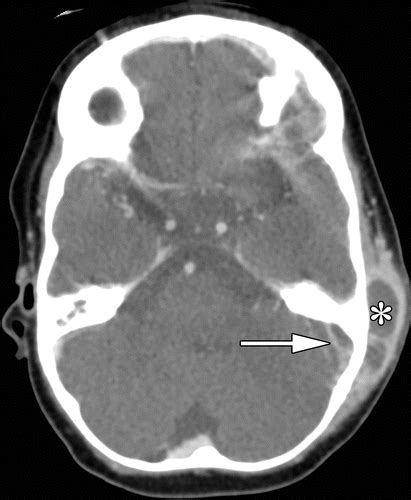 Superior Sagittal Sinus Thrombosis