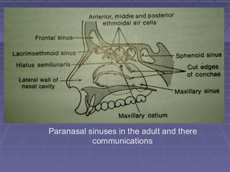 posterior wall maxillary sinus