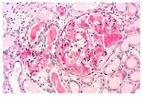 Renal Biopsy Showing Obliteration Of Glomerular Architecture By