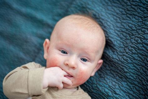 اسم تحليل حساسية الألبان عند الرضع