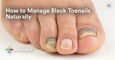 Black Toenails Also Known As Runners Toes Are Rather Common They