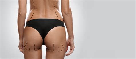 Brazilian Butt Lift Procedure By Black Plastic Surgeon Dr Kentse Moeketsi