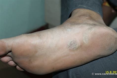 A Case Of Psoriasis At Feet Homeo Energy