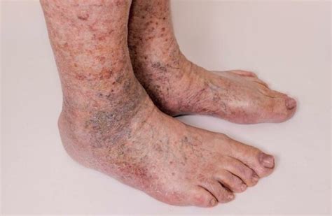 Stasis Dermatitis Chandigarh Ayurved And Panchakarma Centre