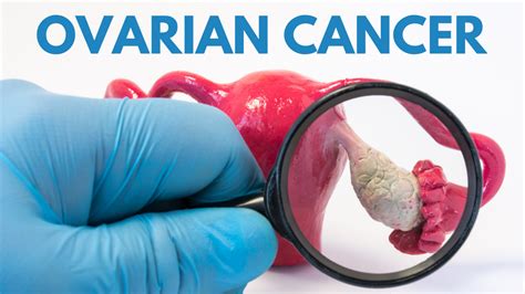 Ovarian Cancer Why Early Diagnosis Is So Important Intrust Care