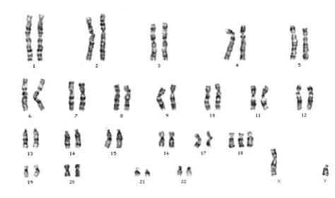 Karyotype Profile Of A Person S Chromosomes