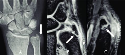 Non Displaced Fracture At The Base Of The Styloid Process Of The Ulna