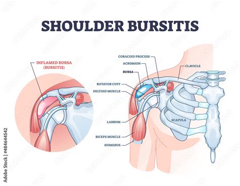 Stockvector Shoulder Bursitis As Medical Painful Bursa Inflammation Outline Diagram Labeled