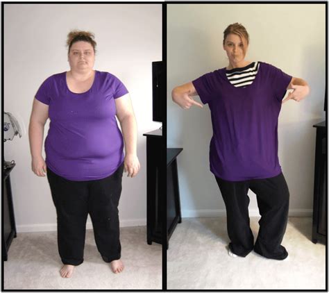 Roux En Y Gastric Bypass Before After